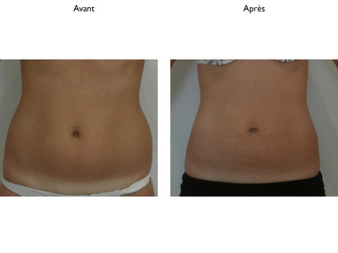 Cryo patiente 3